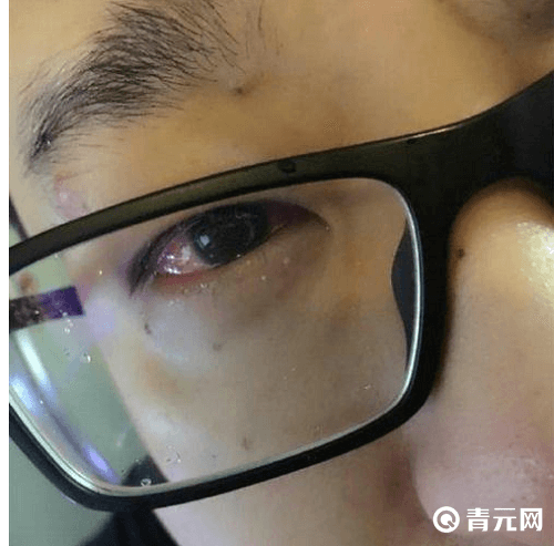 孙亚龙患有眼疾